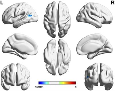 A Comparative Study on the Predictive Value of Different Resting-State Functional Magnetic Resonance Imaging Parameters in Preclinical Alzheimer's Disease